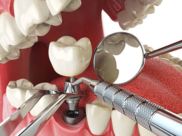 Best Emergency Wisdom Tooth Extraction in Emerald Bay, TX